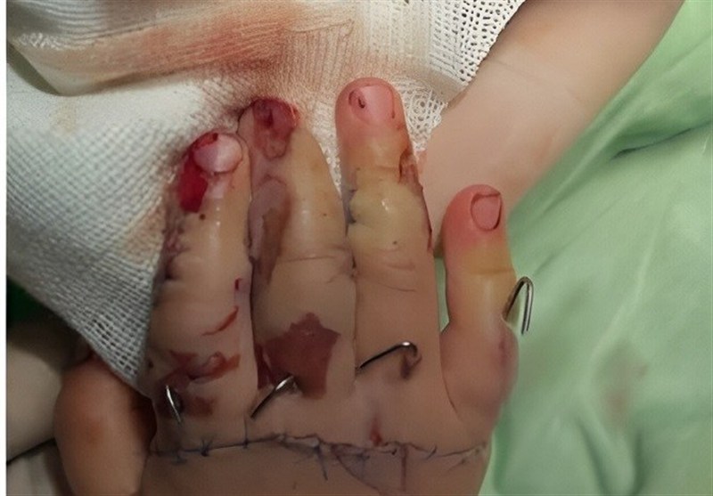 پیوند انگشتان دختربچه یک‌ساله با جراحی 7 ساعته در خرم‌آباد