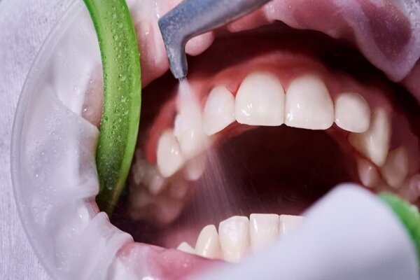 جرم گیری، روشی موثر برای جلوگیری از پوسیدگی دندان و بیماری لثه