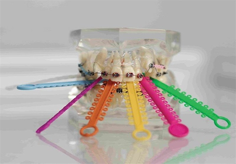 چرا انتخاب ابزار ارتودنسی در موفقیت درمان مهم است؟