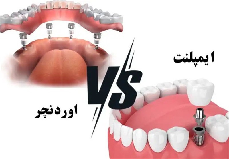 تفاوت ایمپلنت و اوردنچر؛ کدام روش برای جایگزینی دندان مناسب‌تر است؟