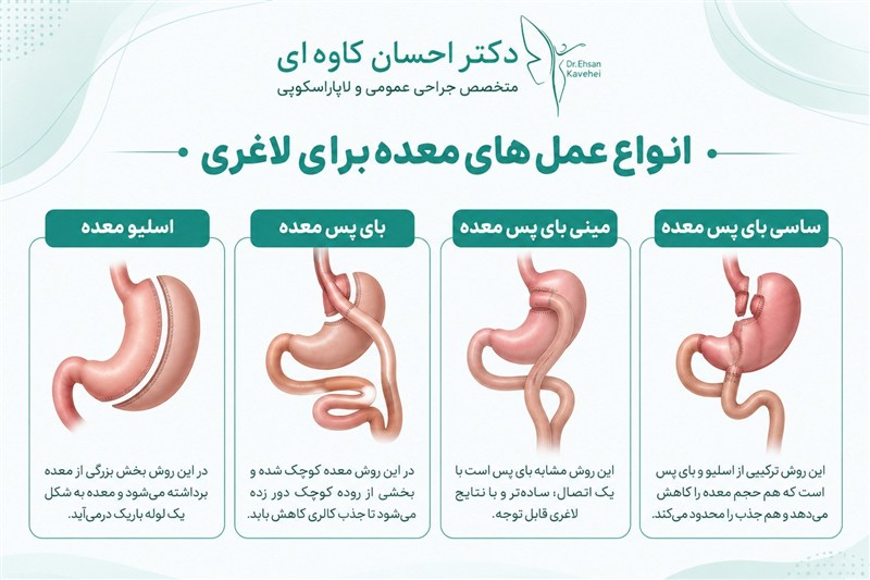 انواع عمل های معده برای لاغری
